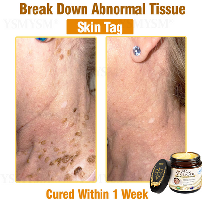 Royal Melbourne Hospital Dermatology Recommended | Official Store | YSMYSM® Full-Body Repair Cream: Anti-Aging, Hydration, Skin Repair, Even Tone, Acne & Dark Spot Treatment, Wart & Mole Removal, Psoriasis Relief