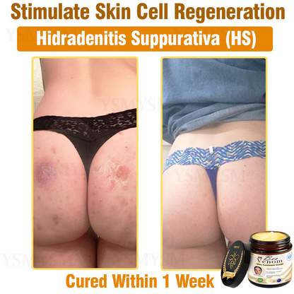 Royal Melbourne Hospital Dermatology Recommended | Official Store | YSMYSM® Full-Body Repair Cream: Anti-Aging, Hydration, Skin Repair, Even Tone, Acne & Dark Spot Treatment, Wart & Mole Removal, Psoriasis Relief