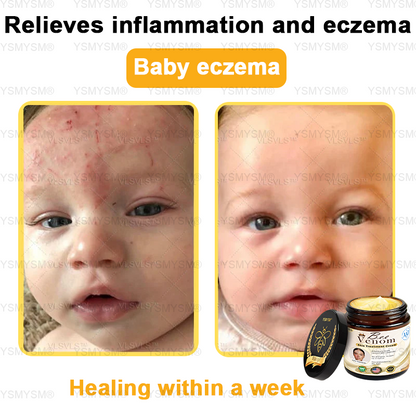 Royal Melbourne Hospital Dermatology Recommended | Official Store | YSMYSM® Full-Body Repair Cream: Anti-Aging, Hydration, Skin Repair, Even Tone, Acne & Dark Spot Treatment, Wart & Mole Removal, Psoriasis Relief